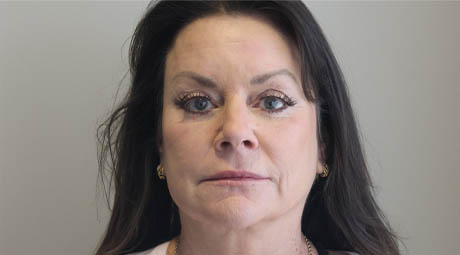 1_0000_Full Face After.jpg