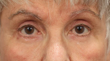 1_0000_lowerlids (1).jpg