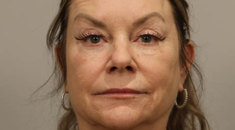 1_0001_Full Face Before.jpg