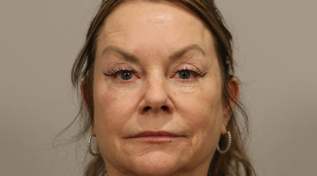 1_0001_Full Face Before.jpg