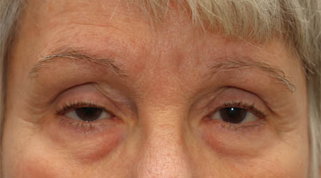 1_0001_lowerlids (2).jpg