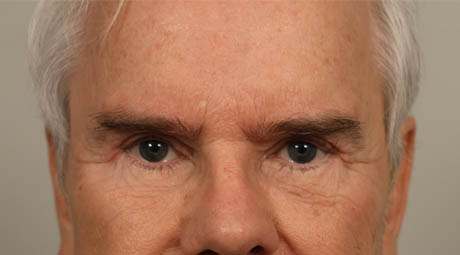 1_0002_maleeyelid (2).jpg