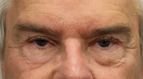 1_0003_maleeyelid (3).jpg