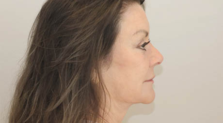 1_0004_Right Side After.jpg