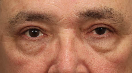 1_0004_maleupperlids (1).jpg