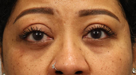 1_0004_ptosis3 (1).jpg