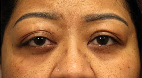 1_0005_ptosis3 (2).jpg