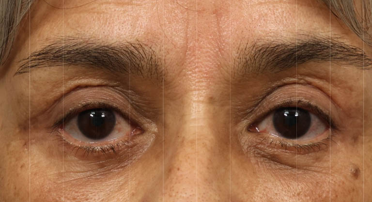 1_0011_quadblephbrowlift5.jpg