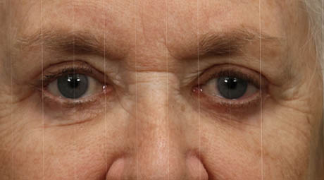 1_0013_Upper & Lower Blepharoplasty With Fat Grafting (1).jpg