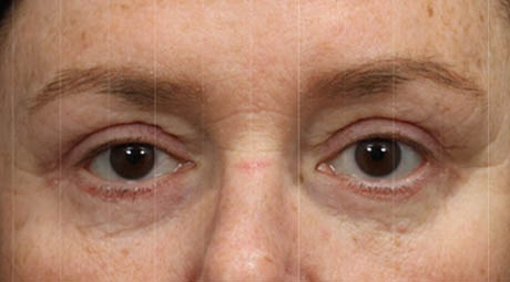 1_0015_Upper & Lower Blepharoplasty With Fat Grafting (2).jpg