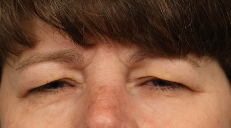 1_0033_upperbrowlift (2).jpg