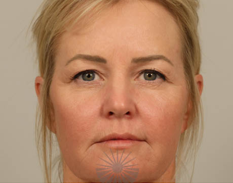 facelift (1)