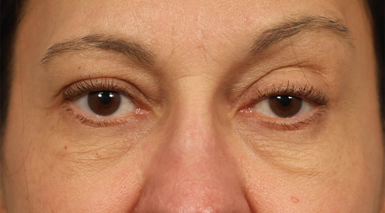 1_0026_HLbrowptoquad (1).jpg