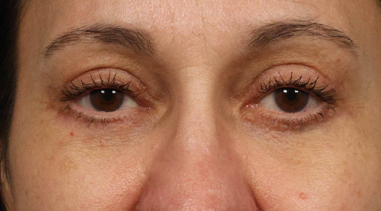 1_0027_HLbrowptoquad (2).jpg