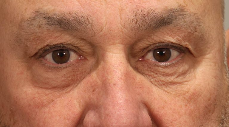 1_0032_PMWedge resection for floppy eyelid syndorome-quad (1).jpg