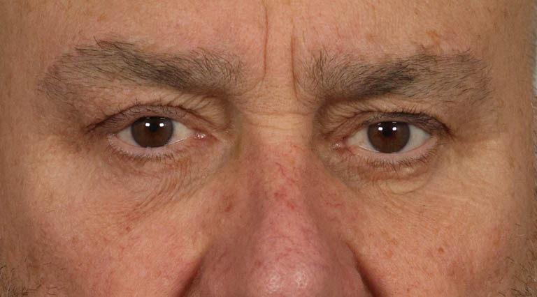 1_0033_PMWedge resection for floppy eyelid syndorome-quad (2).jpg