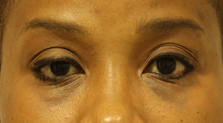 1_0036_SCquadptosis (2).jpg