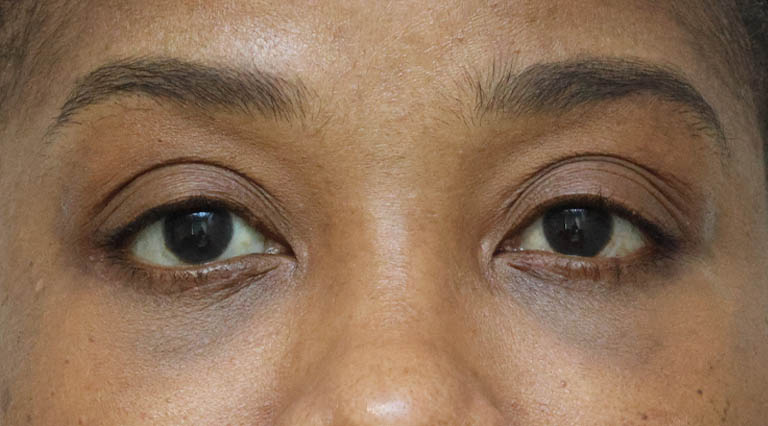 1_0037_SCquadptosis (1).jpg