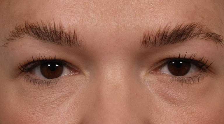 1_0000_FE- Close Up Upper Bleph Before.JPG