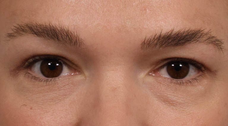 1_0001_FE- Close Up Upper Bleph After.JPG