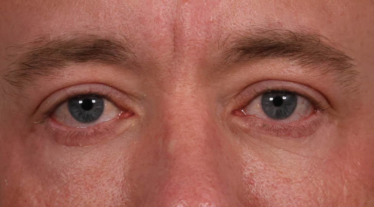 1_0004_HR- Close Up Lower Bleph After.JPG