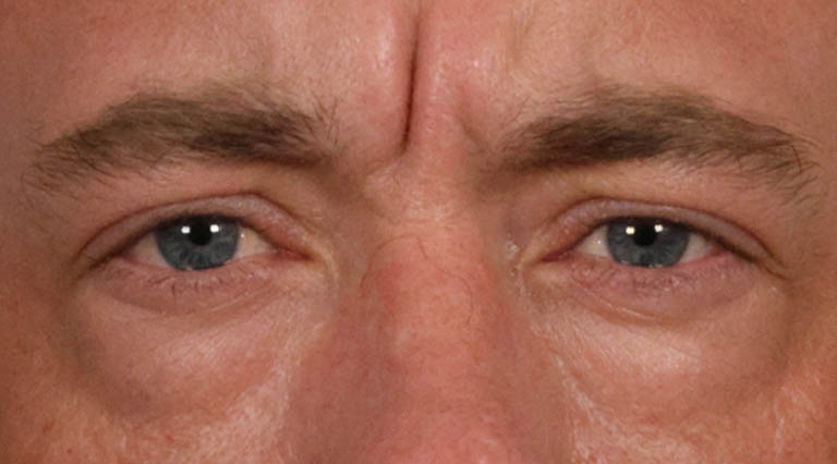 1_0005_HR- Close Up Lower Bleph Before.JPG