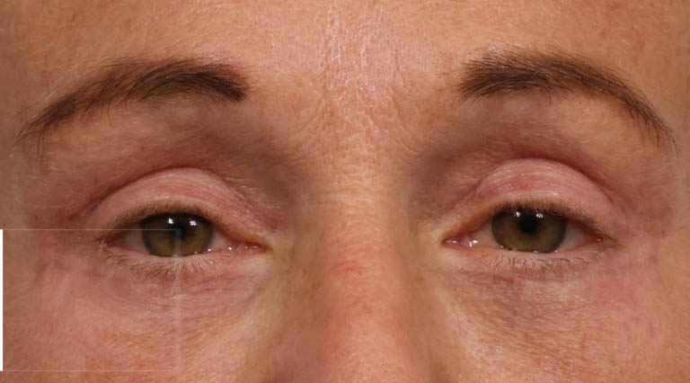 1_0008_SN- Close Up After Lower Bleph + Brow after.JPG