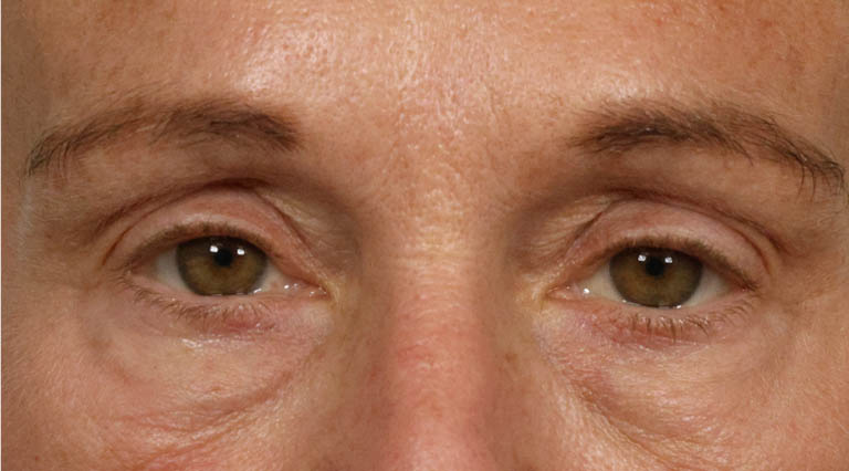 1_0009_SN- Close Up After Lower Bleph + Brow Before.JPG