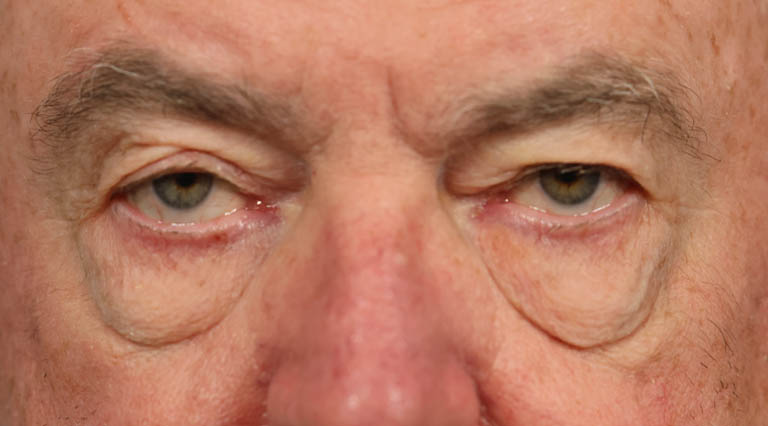 ptosis (2)