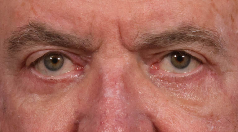 ptosis (3)